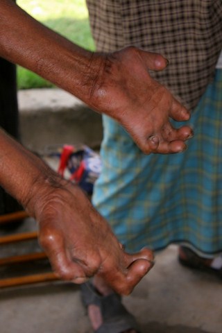 cr-leprosy-clinic-11-640